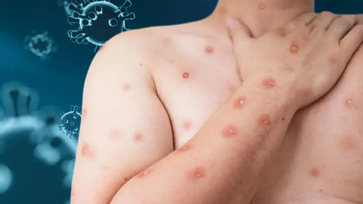 Inicia capacitación virtual para diagnosticar el mpox en México